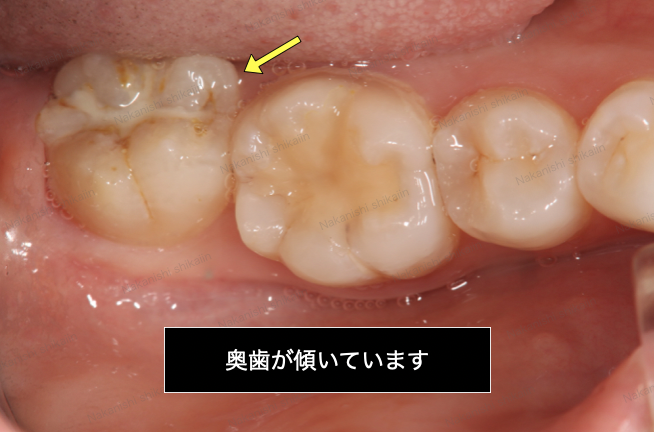 歯科　片側咬合器　保存修復 補綴修復実習用顎模型 [D16FE-500A(GSE)-QF](FE咬合器つき)｜株式会社